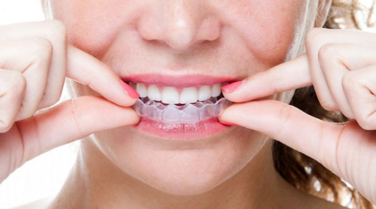 Những phương pháp niềng răng phổ biến