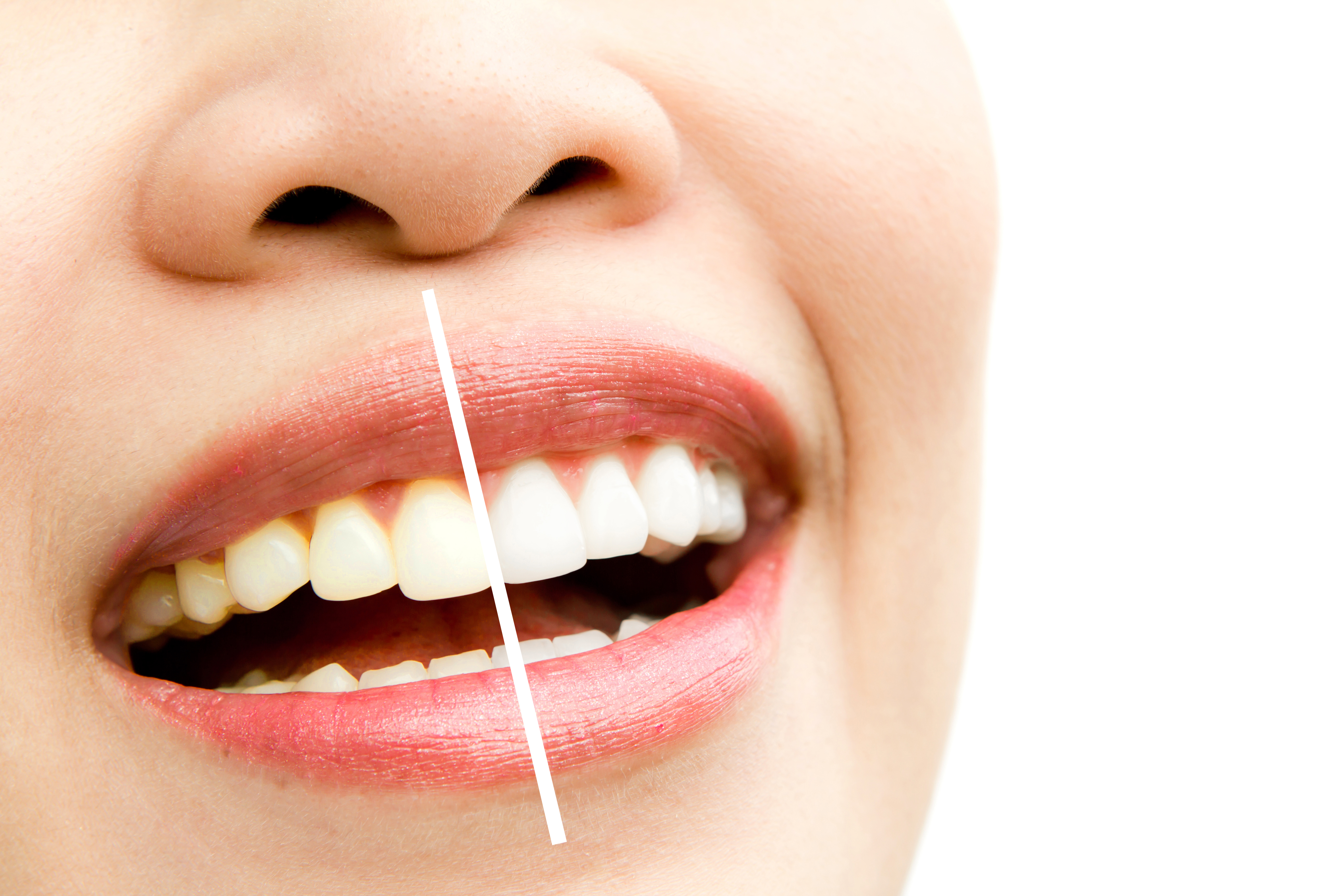 Tẩy trắng răng tại nhà hay tại nha khoa?