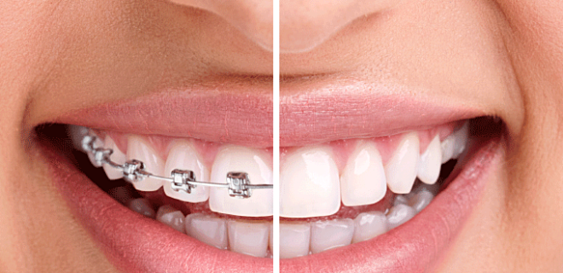 Các yếu tố ảnh hưởng đến chi phí niềng răng?