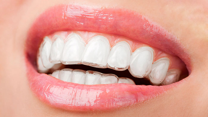 Cách chữa răng vẩu được nhiều người biết đến nhất?