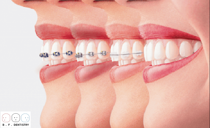 Niềng răng thẩm mỹ có ưu và nhược điểm gì?