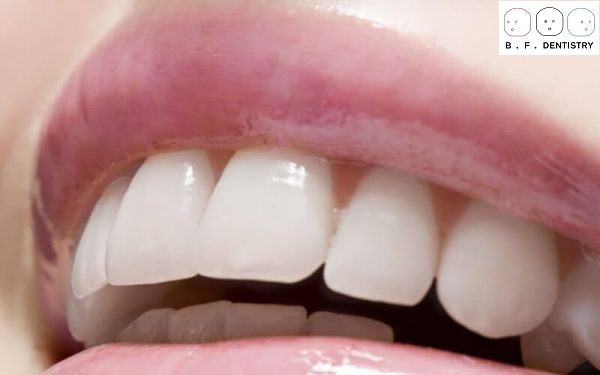 Răng cửa vẩu gây ra những tác hại gì?