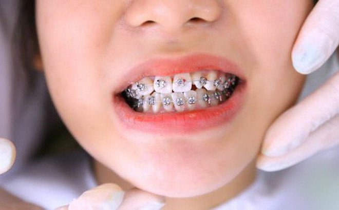 Cách sửa răng thưa ở trẻ em?
