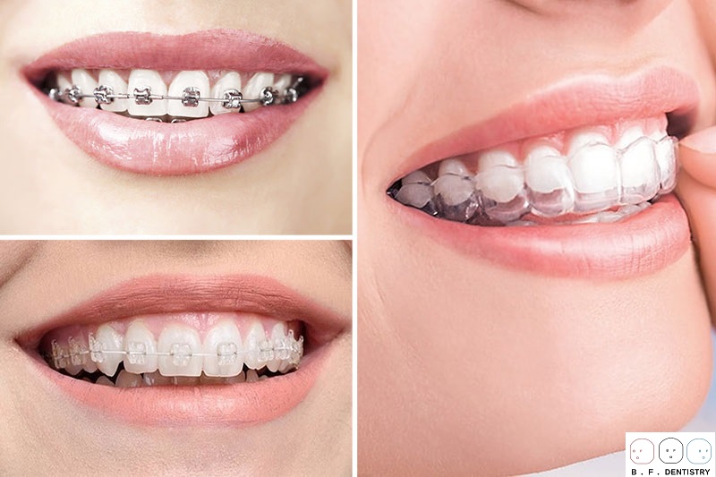Trị răng thưa bằng niềng răng có tốt không?