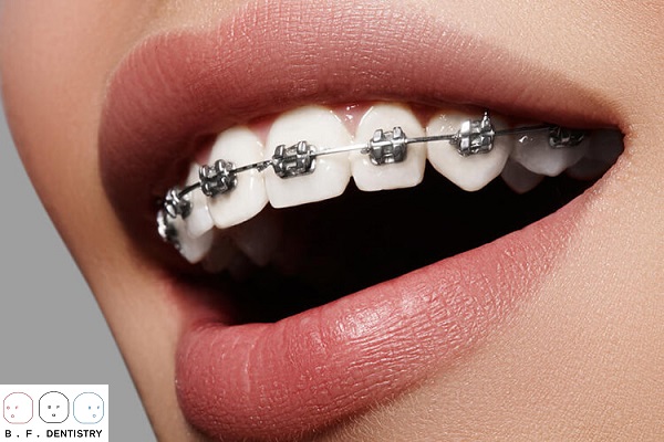 Niềng răng thẩm mỹ ở đâu đẹp nhất?
