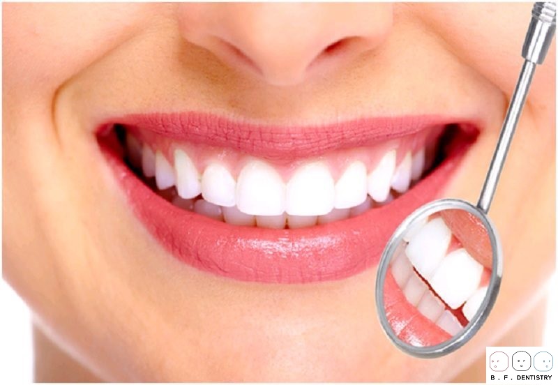 Có nên khắc phục răng cửa thưa bằng bọc răng sứ?