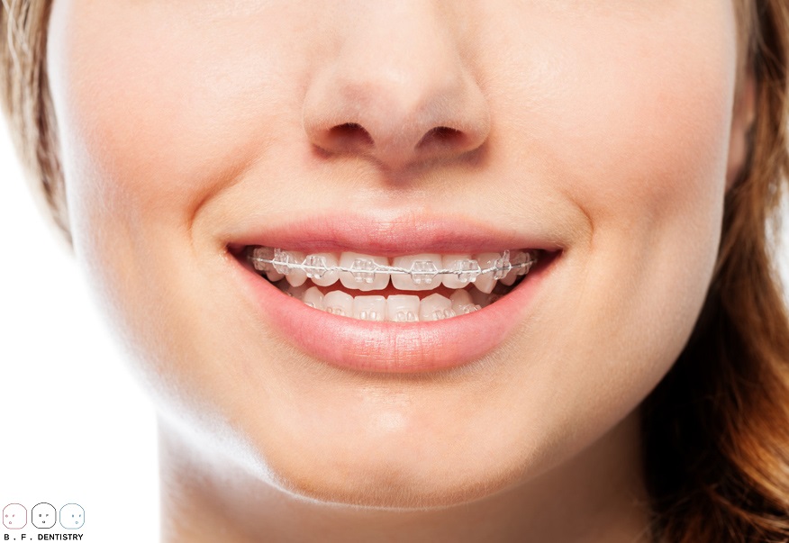 Cách khắc phục răng bị thưa mà ai cũng nên biết?
