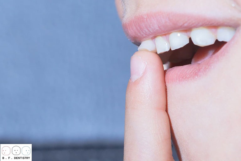 Cần phải làm gì khi răng cửa bị lung lay?