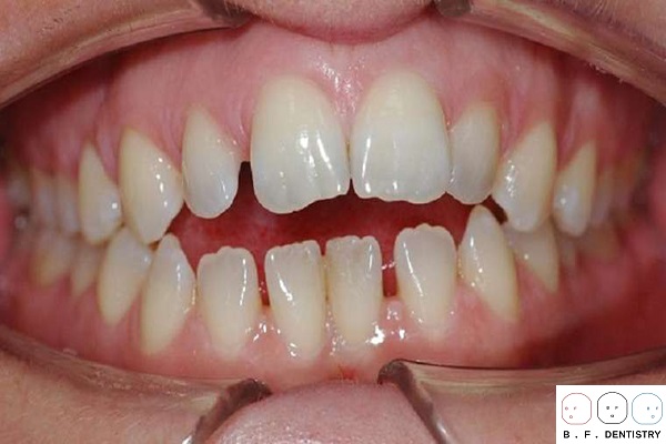 Nguyên nhân răng thưa dần là vì lý do gì?
