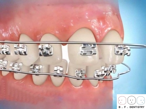 Cách chữa răng bị thưa được nha sĩ khuyên dùng?