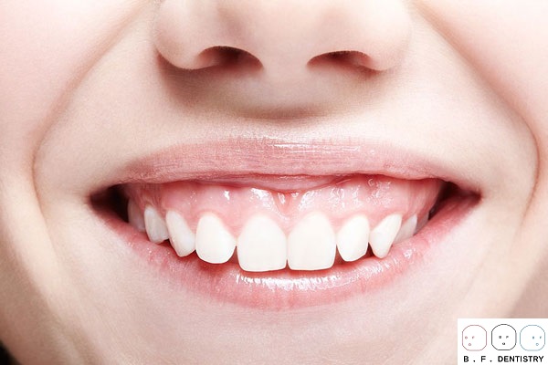 Liệu Niềng Răng Có Hết Cười Hở Lợi Hay Không?
