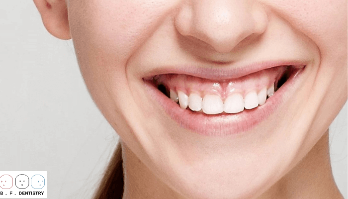 Niềng răng có hết cười hở lợi thật hay không?