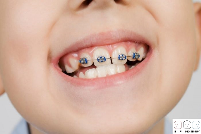 Cách khắc phục răng vẩu ở trẻ em?