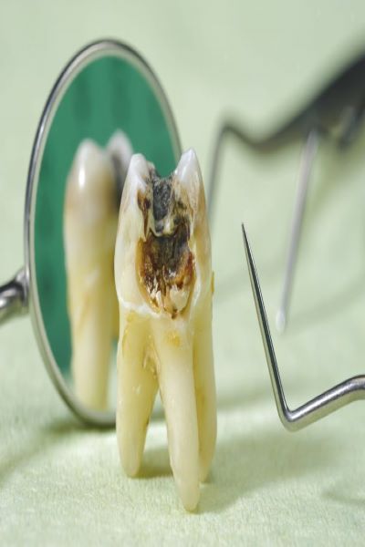 Khi răng bị sâu có niềng được không?