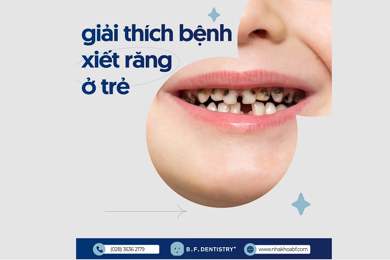 Tìm hiểu bệnh lý xiết ăn răng ở trẻ