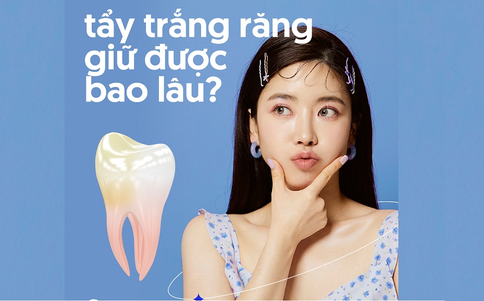 Tẩy trắng răng giữ được bao lâu?