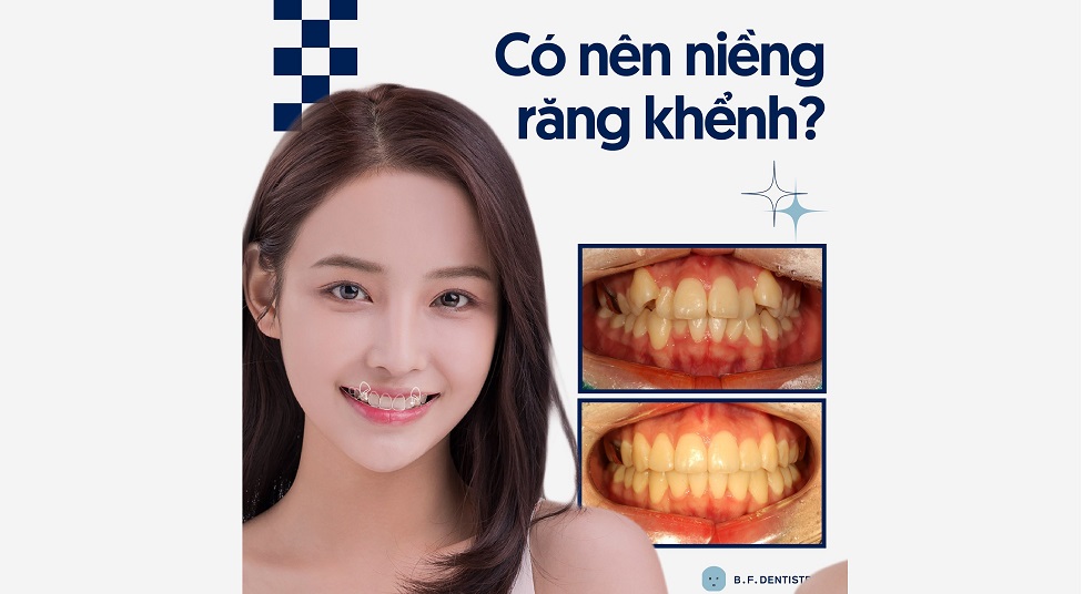 Có nên niềng răng khểnh không?