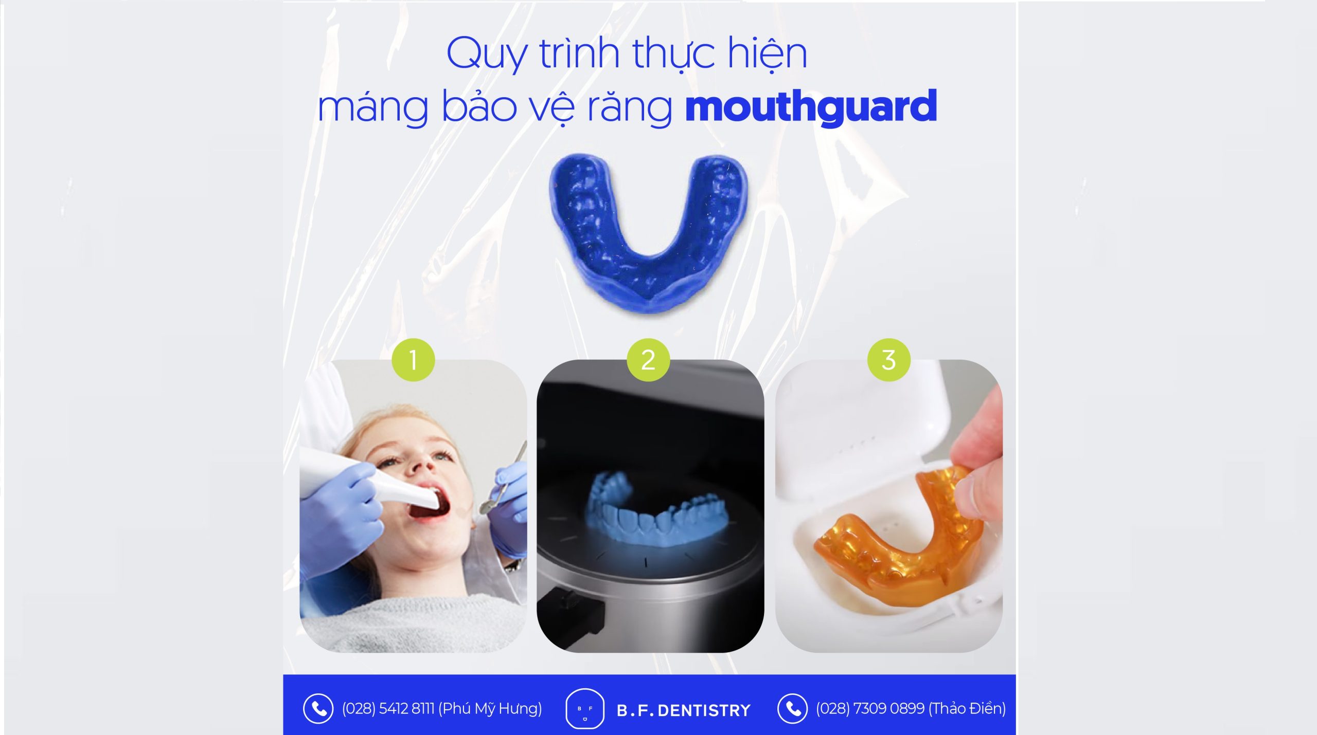 Quy trình thực hiện máng bảo vệ răng mouthguard